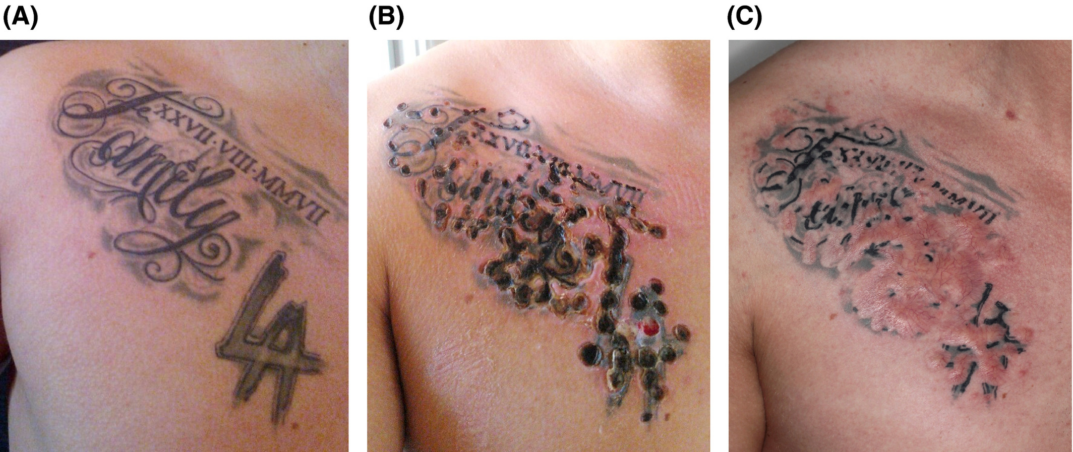 Sequels to tattoo removal by caustic products - Hutton Carlsen - 2018 - Skin Research and Technology - Wiley Online Library